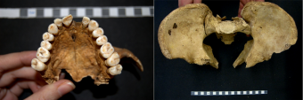 Two images. First image is of teeth from the upper jaw, from underneath. The teeth are worn down. The second image is of a skeletal pelvis, which shows the bones in a characteristic mickey-mouse ear shape.