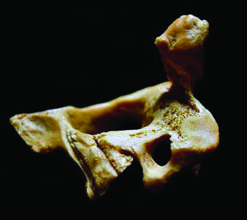 Photo of a human vertebrae showing a cut mark